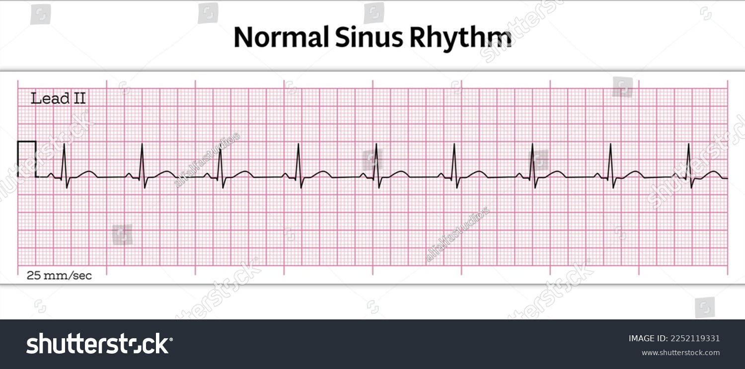 ECG Normal Sinus Rhythm - 8 Second ECG Paper - Vector Medical Illustration #2252119331