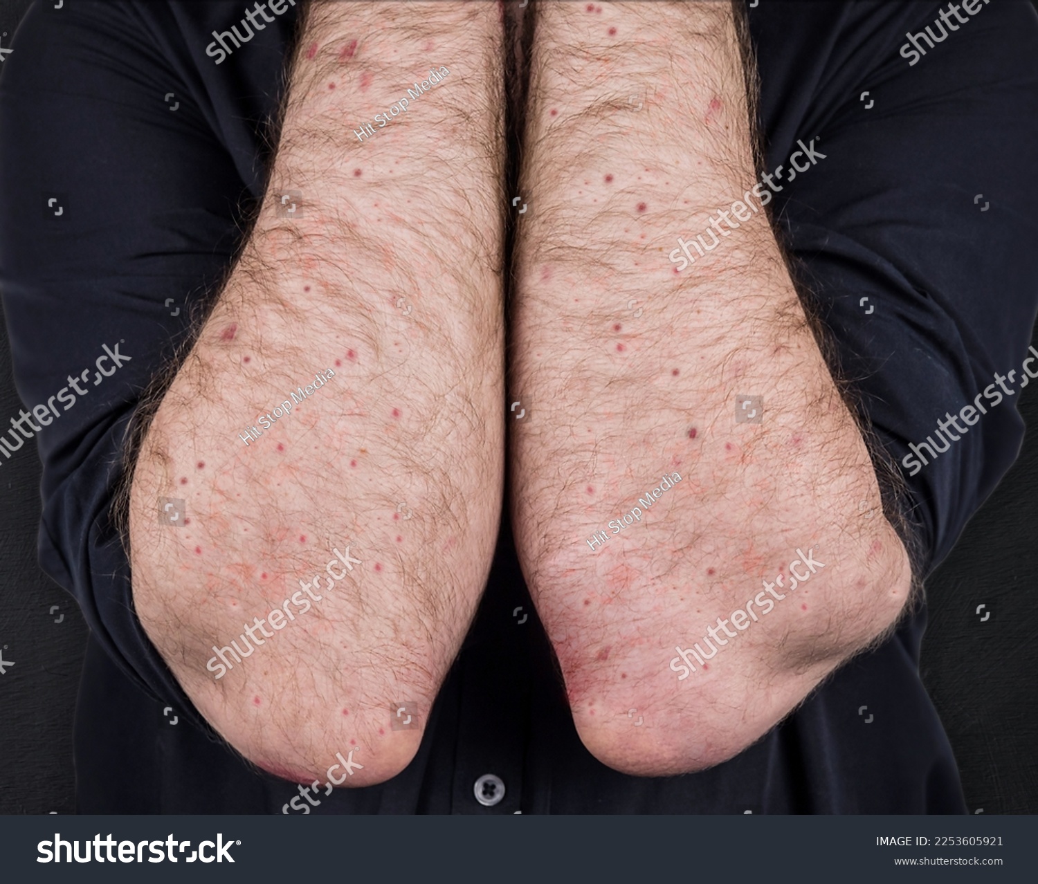 Measles. Viral disease of immunodeficiency dermatitis rash on the body of a man, scratch with itching, viral exanthema. A patient with monkeypox. Painful rash, red spots, blisters on the arm. #2253605921