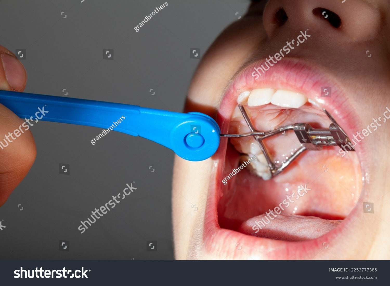 Close up isolated image of a young caucasian girl opening her mouth wide. On upper jaw there is a palatal expander and orthodontist or parent uses a turn key to rotate the screw and adjust expansion. #2253777385