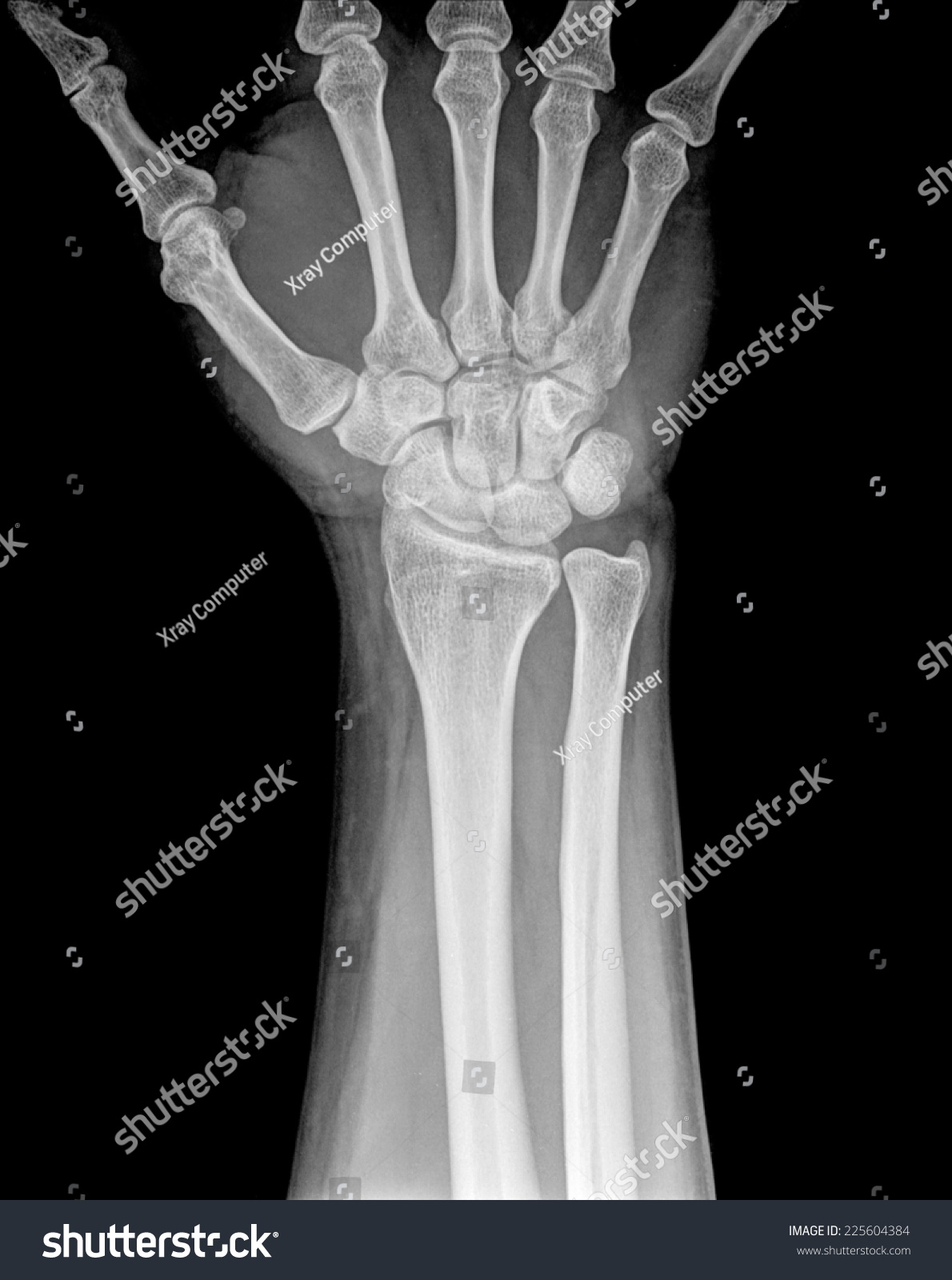 X-ray of human hand and wrist. #225604384