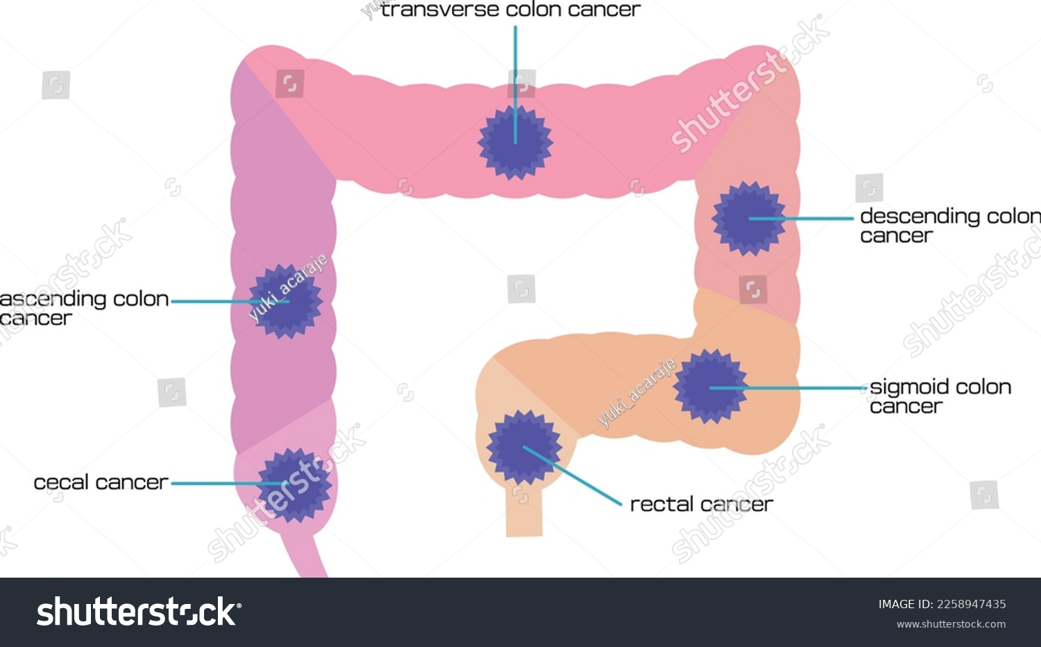 Illustrated Types Of Colorectal Cancer By Site Royalty Free Stock