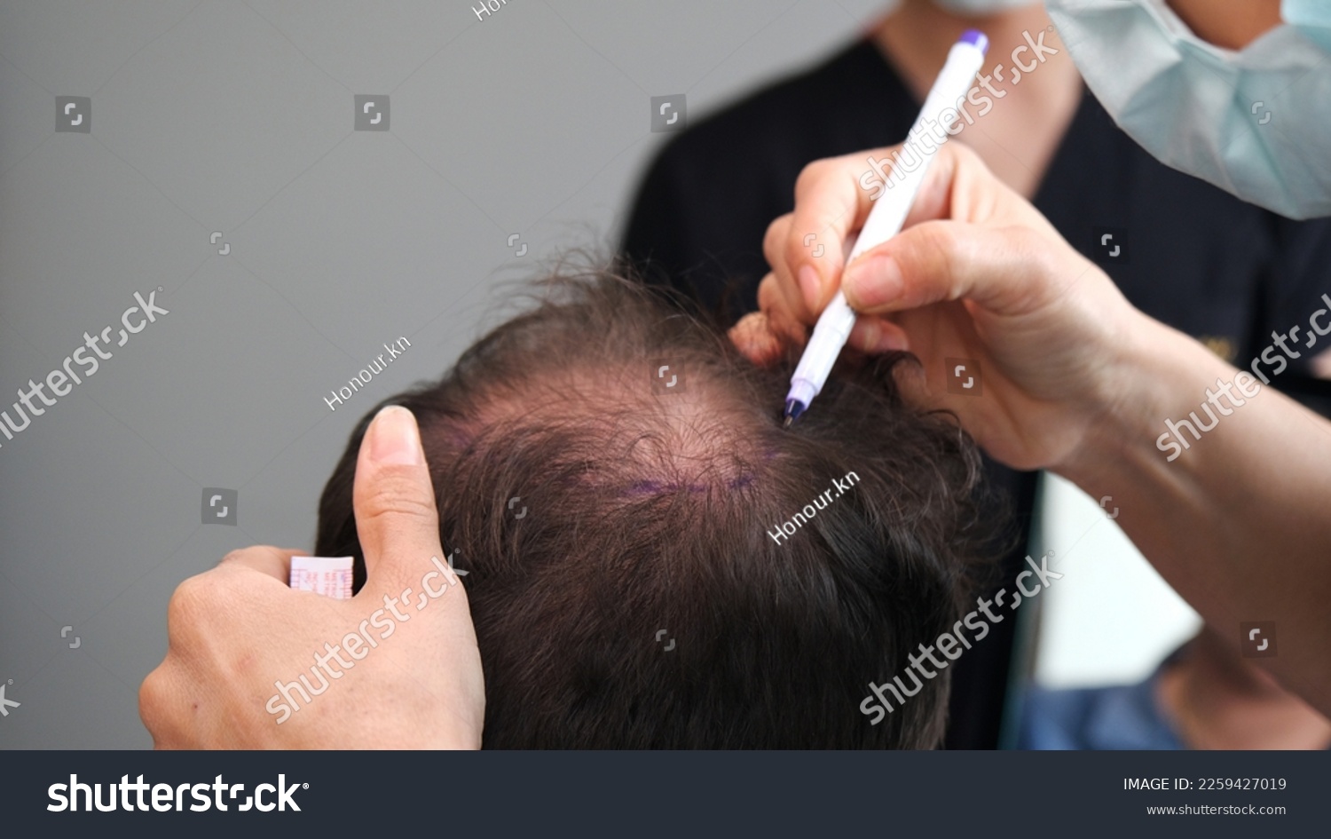 doctor check before hair transplant #2259427019