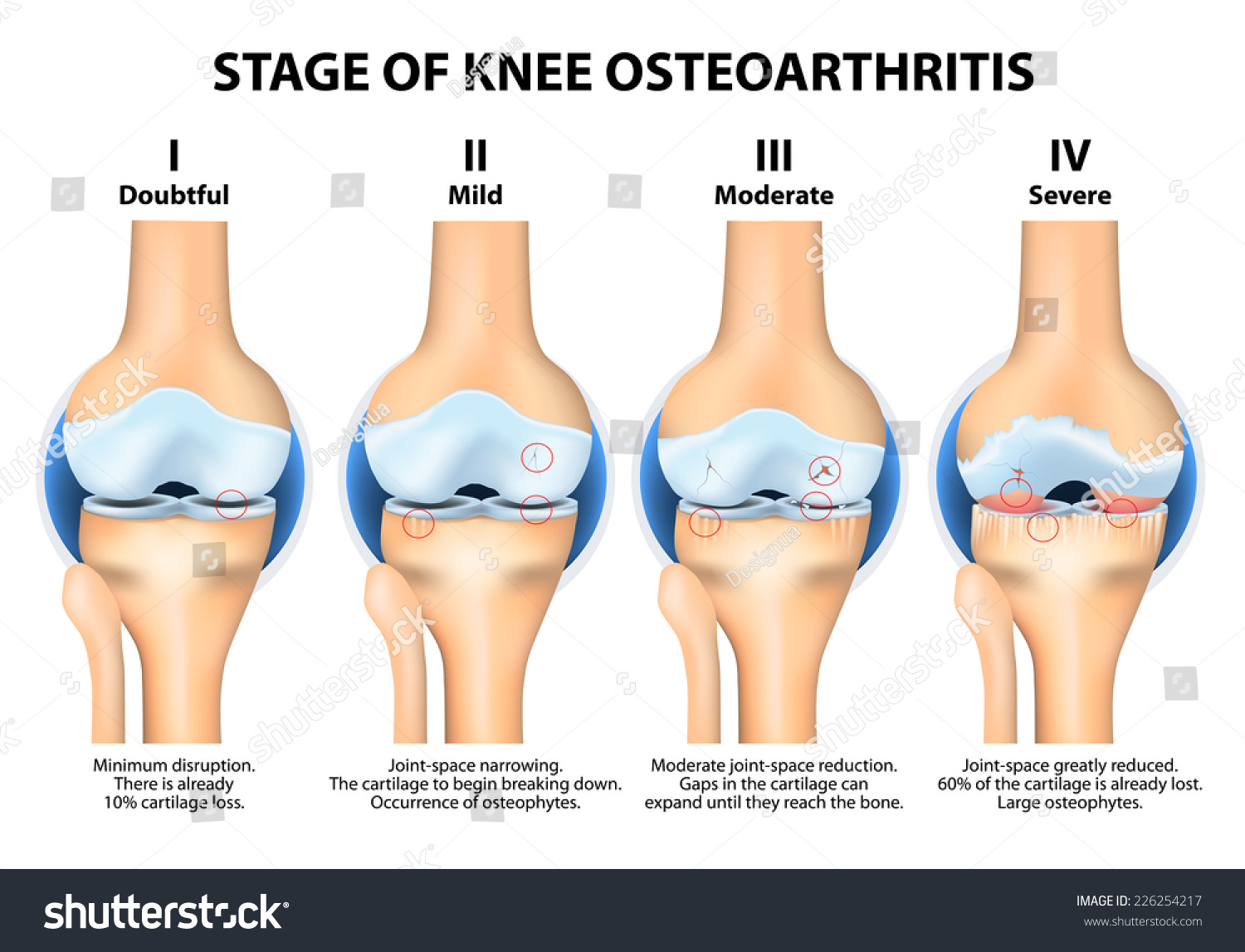 Stages Of Knee Osteoarthritis (OA). Kellgren And - Royalty Free Stock ...