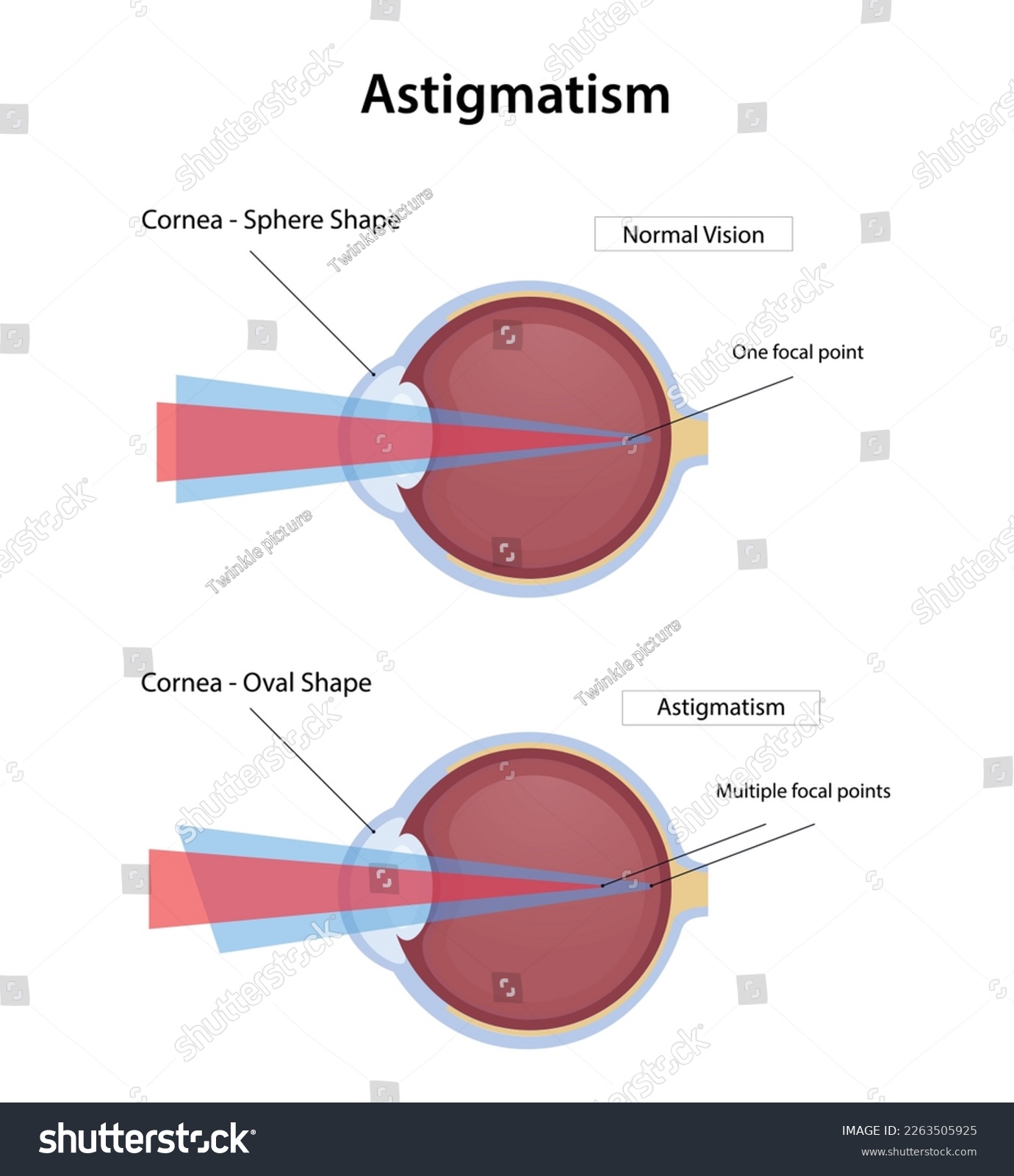 Astigmatism disease, normal vision and - Royalty Free Stock Vector ...