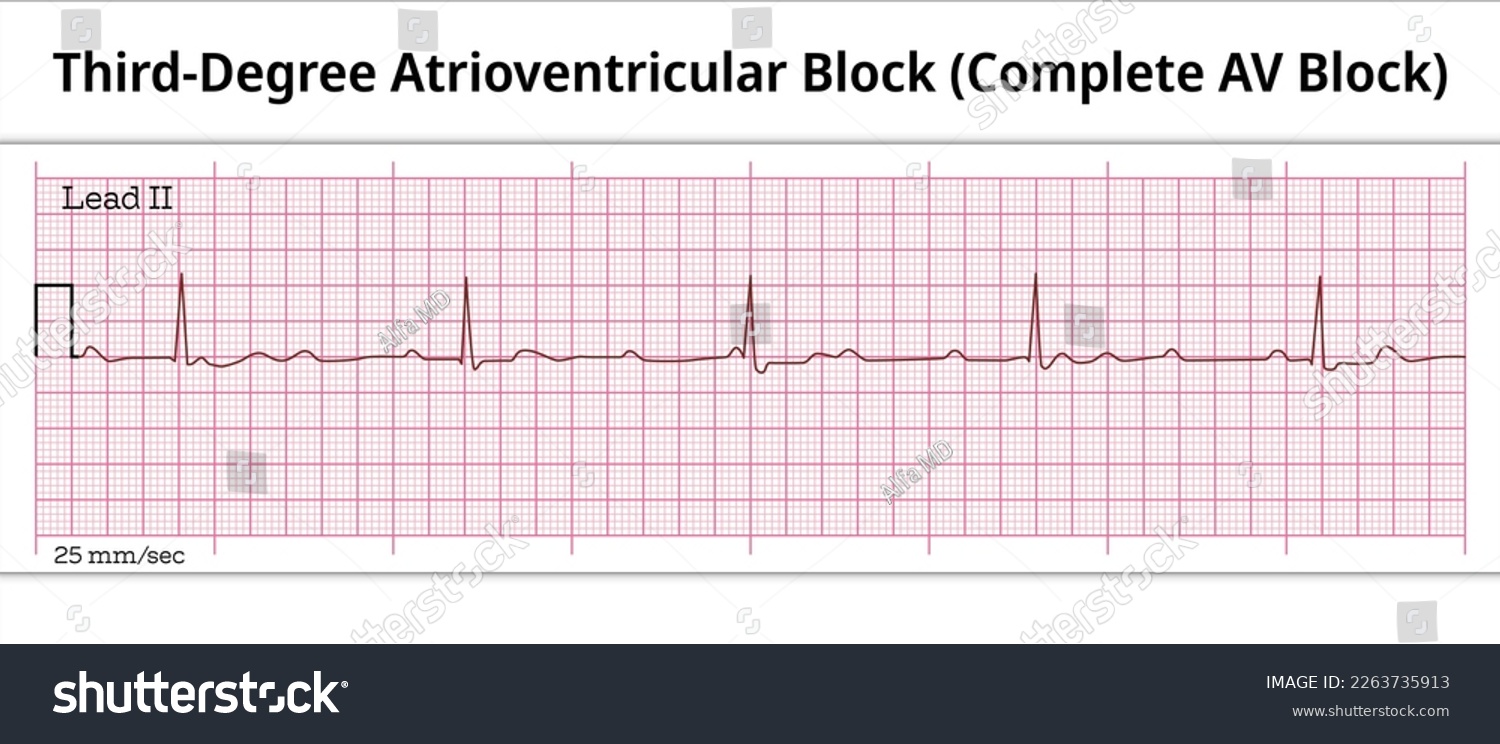 ECG Third Degree Atrioventricular Block - - Royalty Free Stock Vector ...