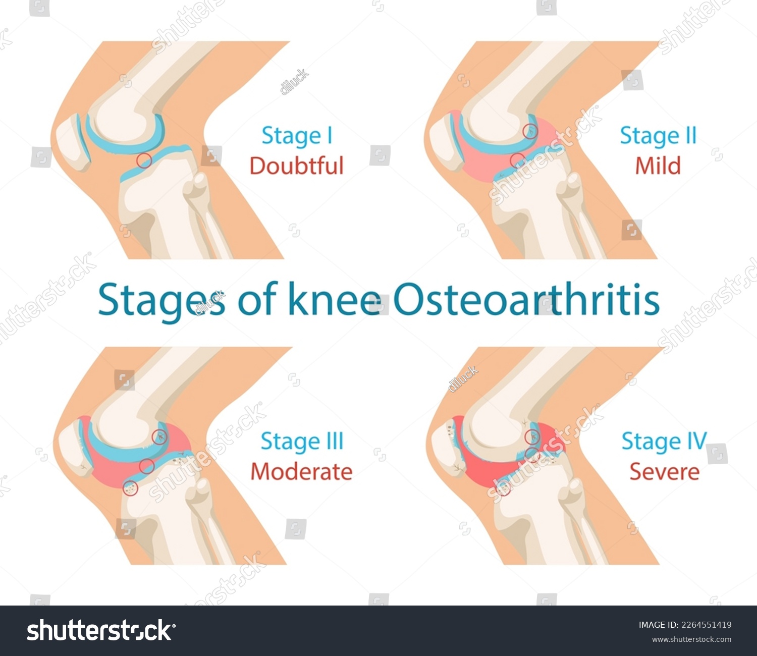 Stages Of Osteoarthritis Of The Knee Main Royalty Free Stock Vector