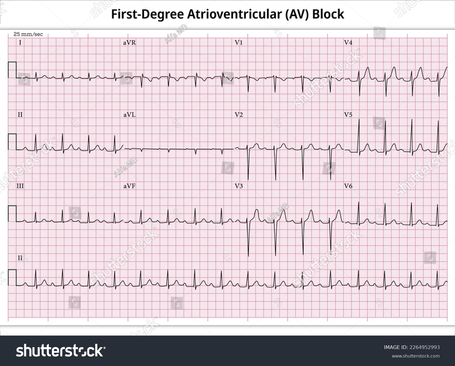 First Degree Atrioventricular Block - ECG Paper - Royalty Free Stock ...