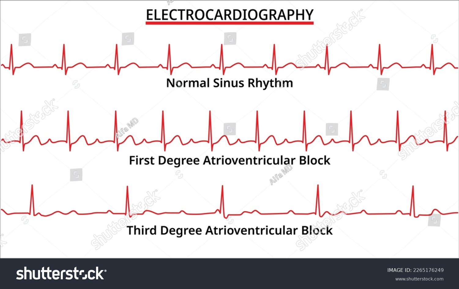 Set of ECG Common Abnormalities - Normal Sinus - Royalty Free Stock ...