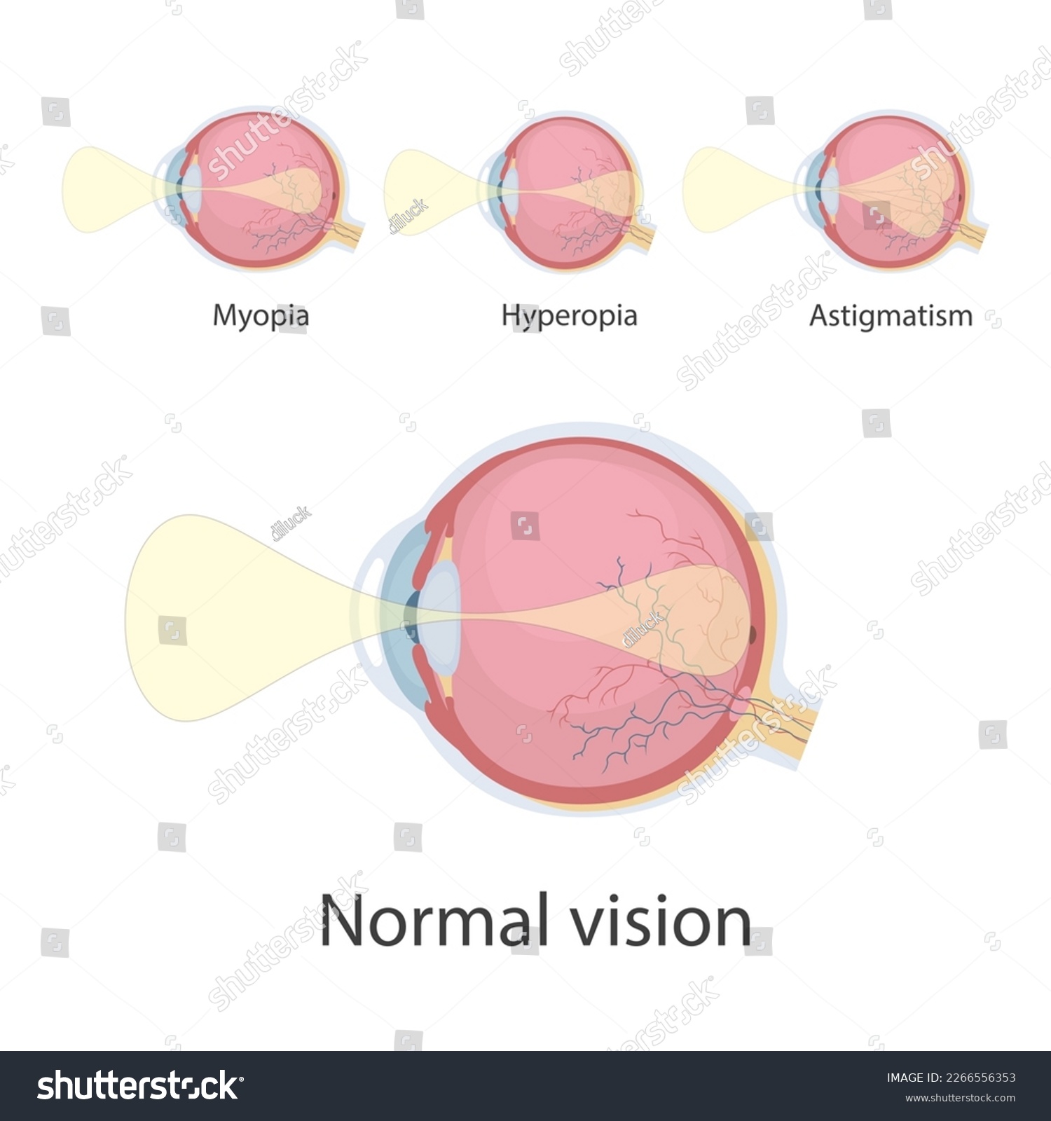 Ophthalmic concept, eye defects. Normal vision, - Royalty Free Stock ...