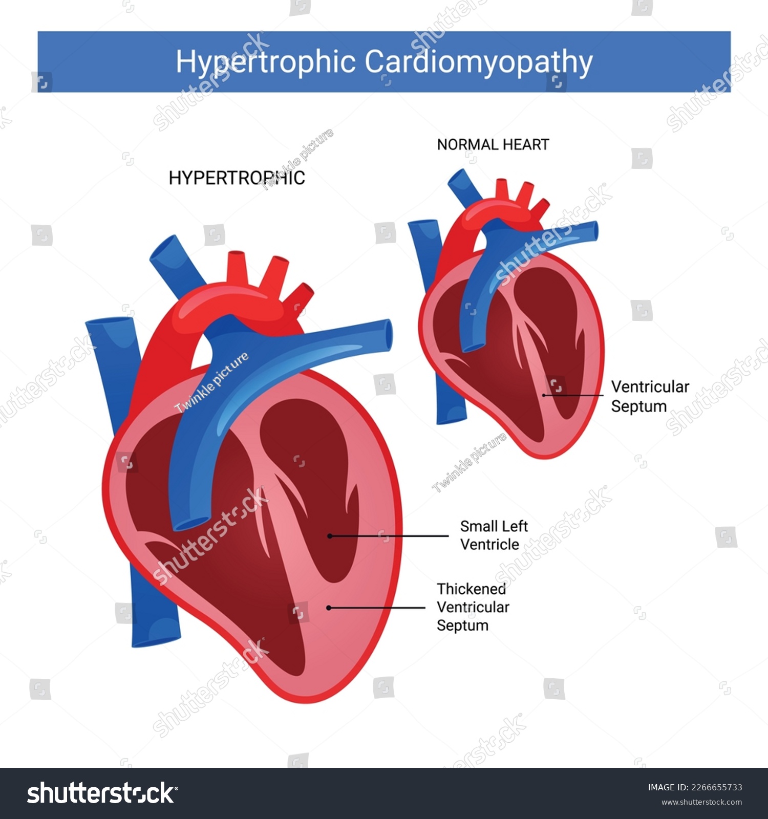 Hypertrophic Cardiomyopathy Difference Normal Royalty Free Stock