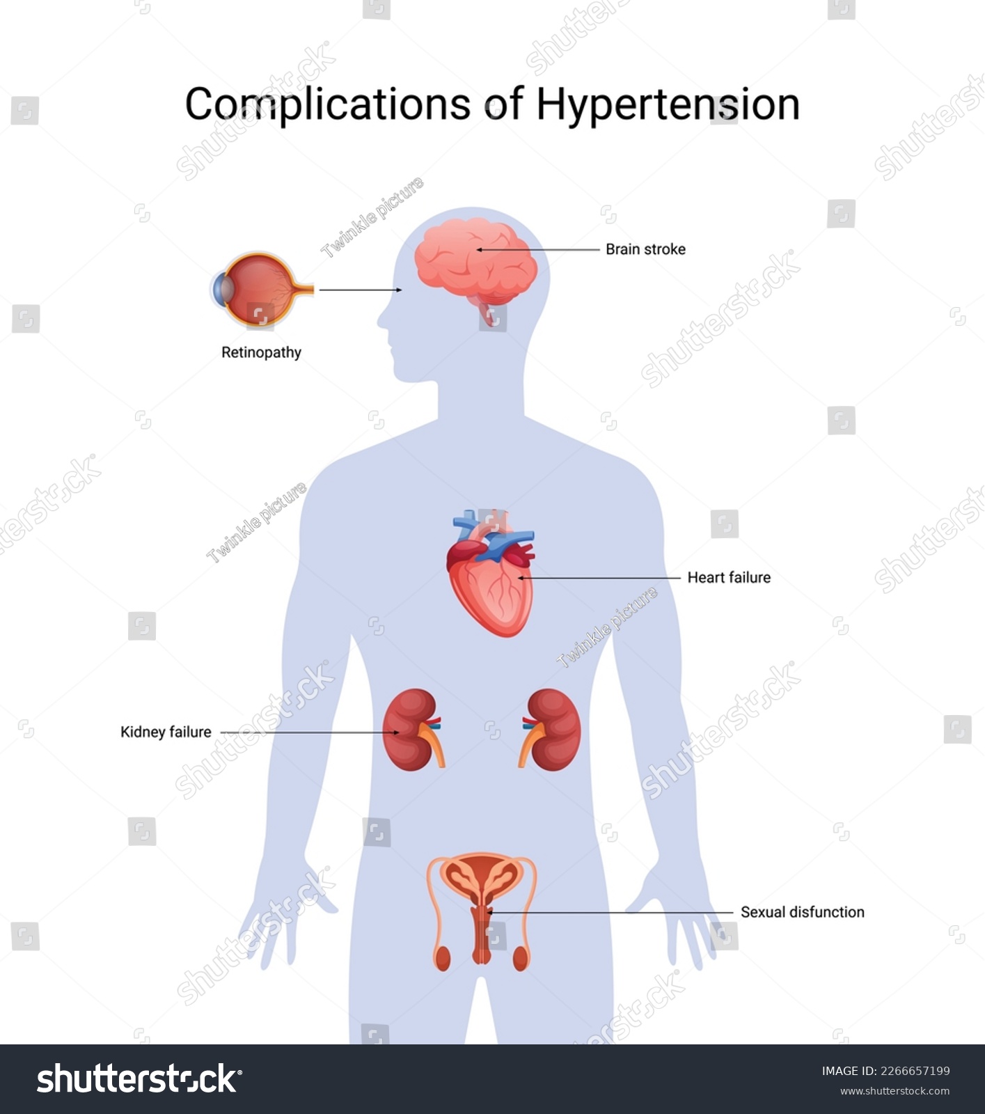 Hypertension complications design illustration. - Royalty Free Stock ...