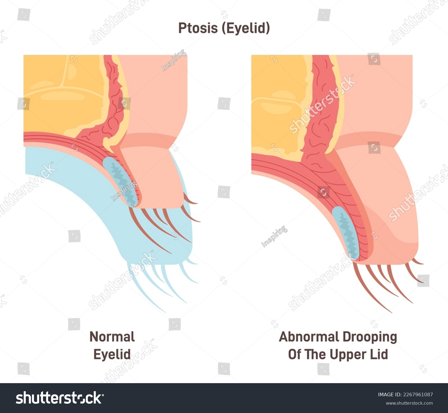 Ptosis. Drooping of the upper eyelid. Lazy eye - Royalty Free Stock ...