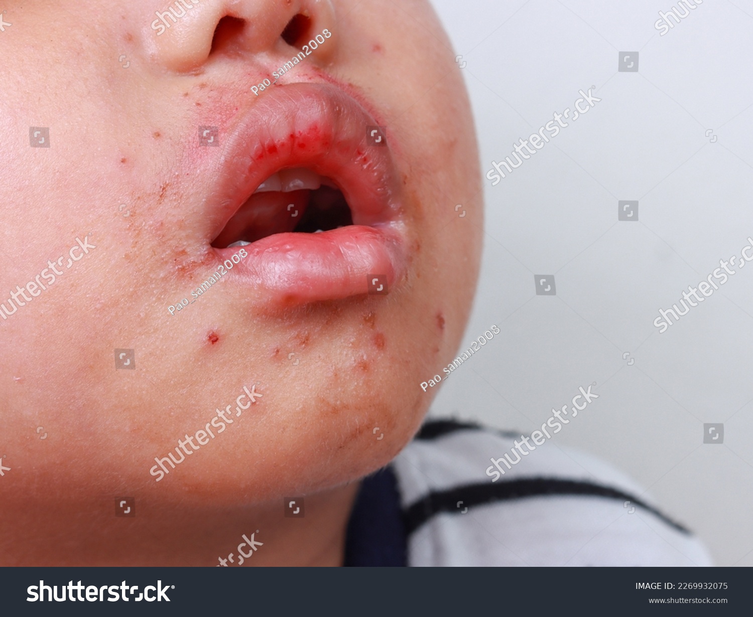 Red spot on mouth Hand foot and mouth disease of - Royalty Free Stock ...