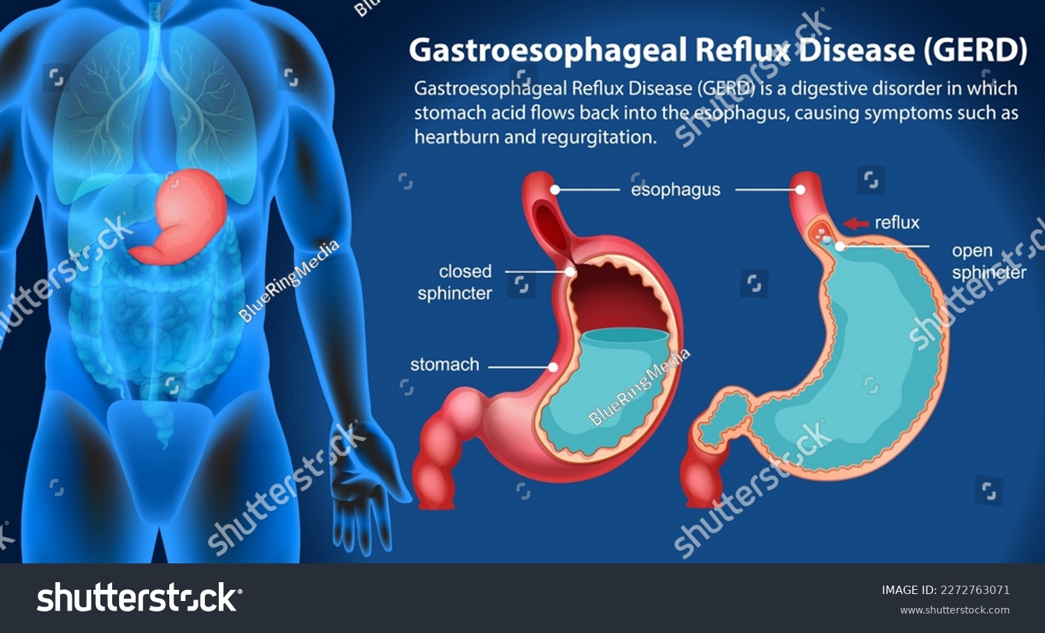 Gastroesophageal Reflux Disease (GERD) Diagram - Royalty Free Stock ...