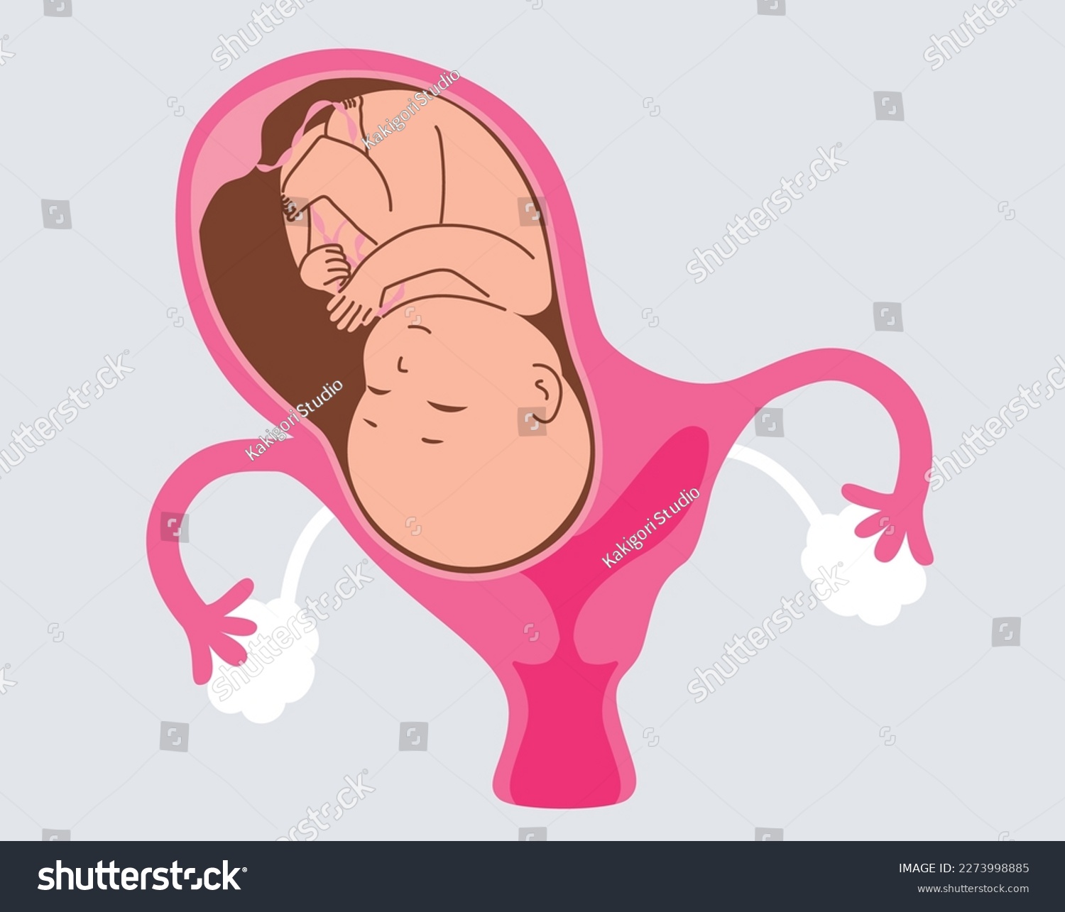 Vector Illustration Of Bicornuate Uterus During Royalty Free Stock Vector 2273998885