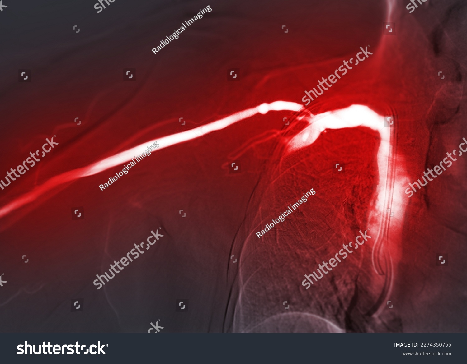 Image of Angioplasty, balloon angioplasty and - Royalty Free Stock ...