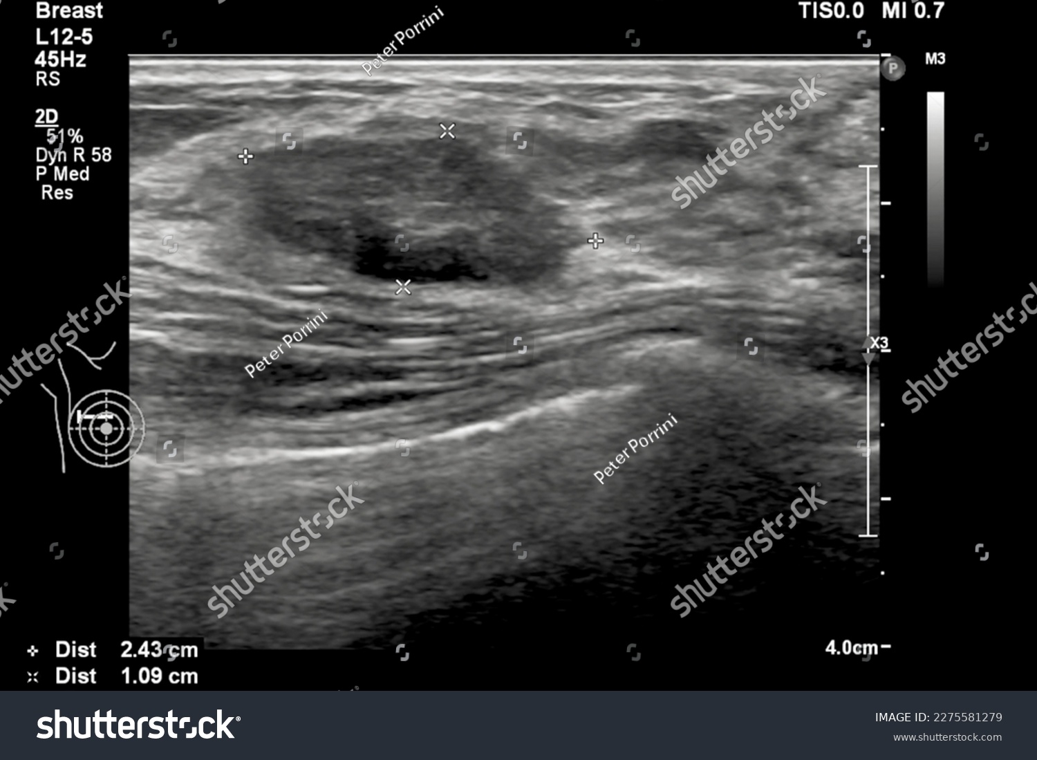 Image of breast ultrasound for cancer checks in women with breast mass.A female with a breast lump was done ultrasonography for breast cancer or tumor screening in the hospital. #2275581279