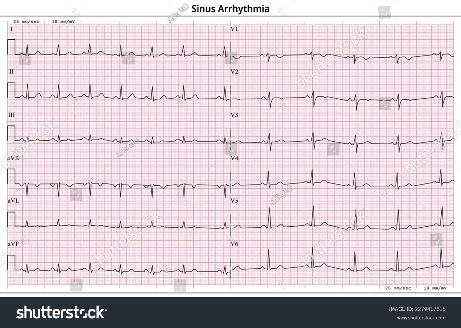 Ecg Sinus Arrhythmia - 12 Lead Ecg Common Case - - Royalty Free Stock 