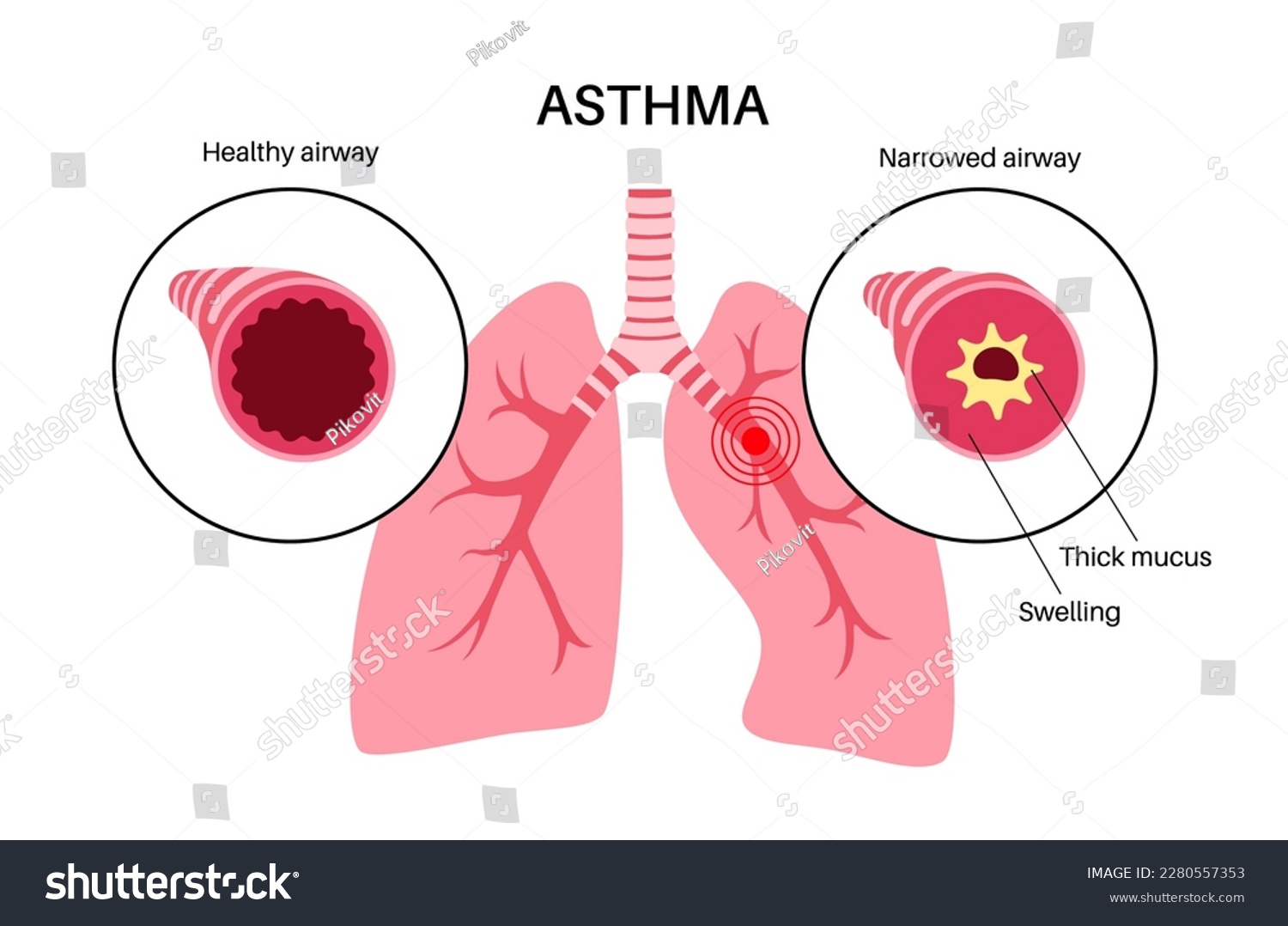 Asthma disease concept. Shortness of breath, - Royalty Free Stock ...