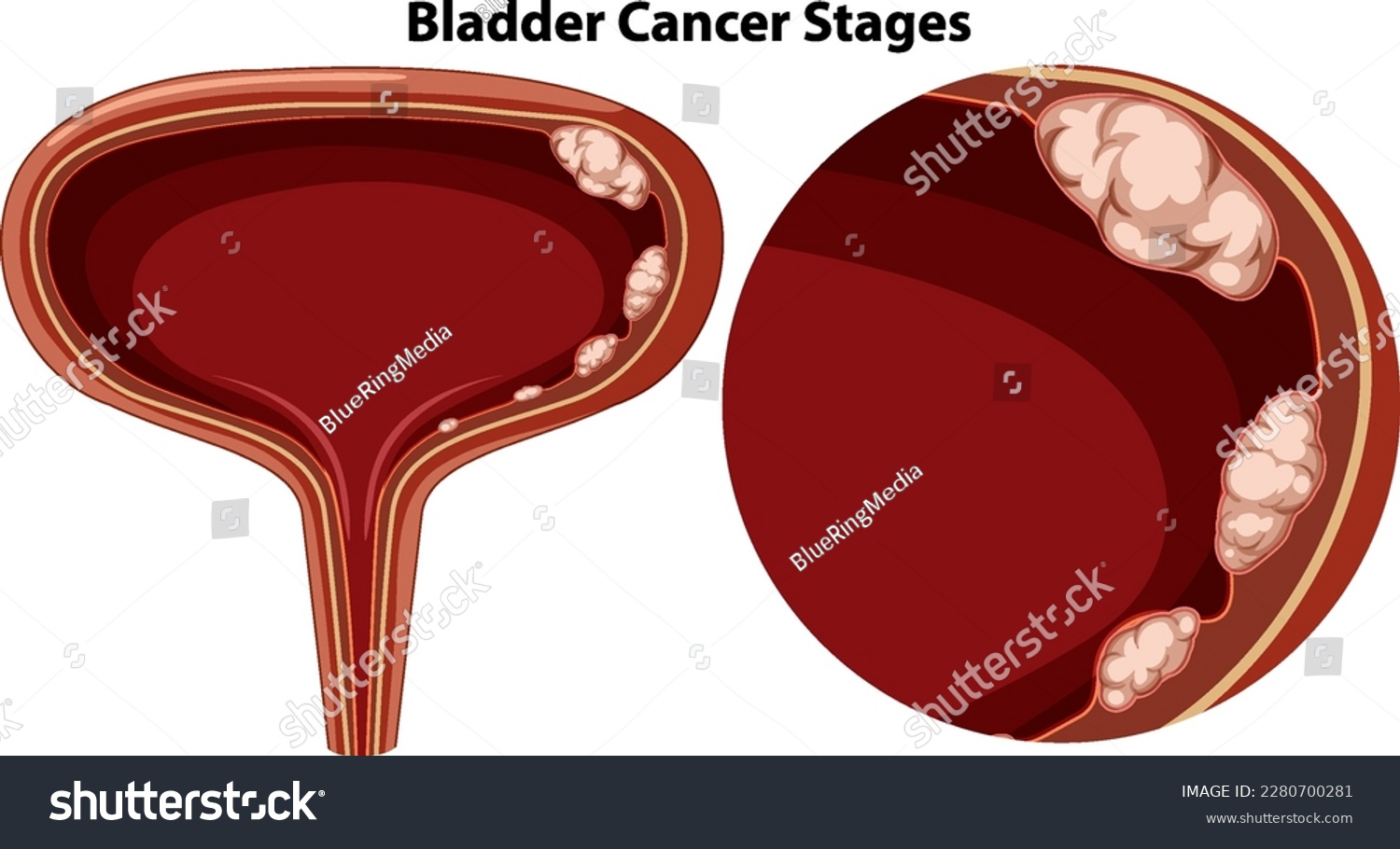 Bladder Cancer Stages Vector illustration - Royalty Free Stock Vector ...