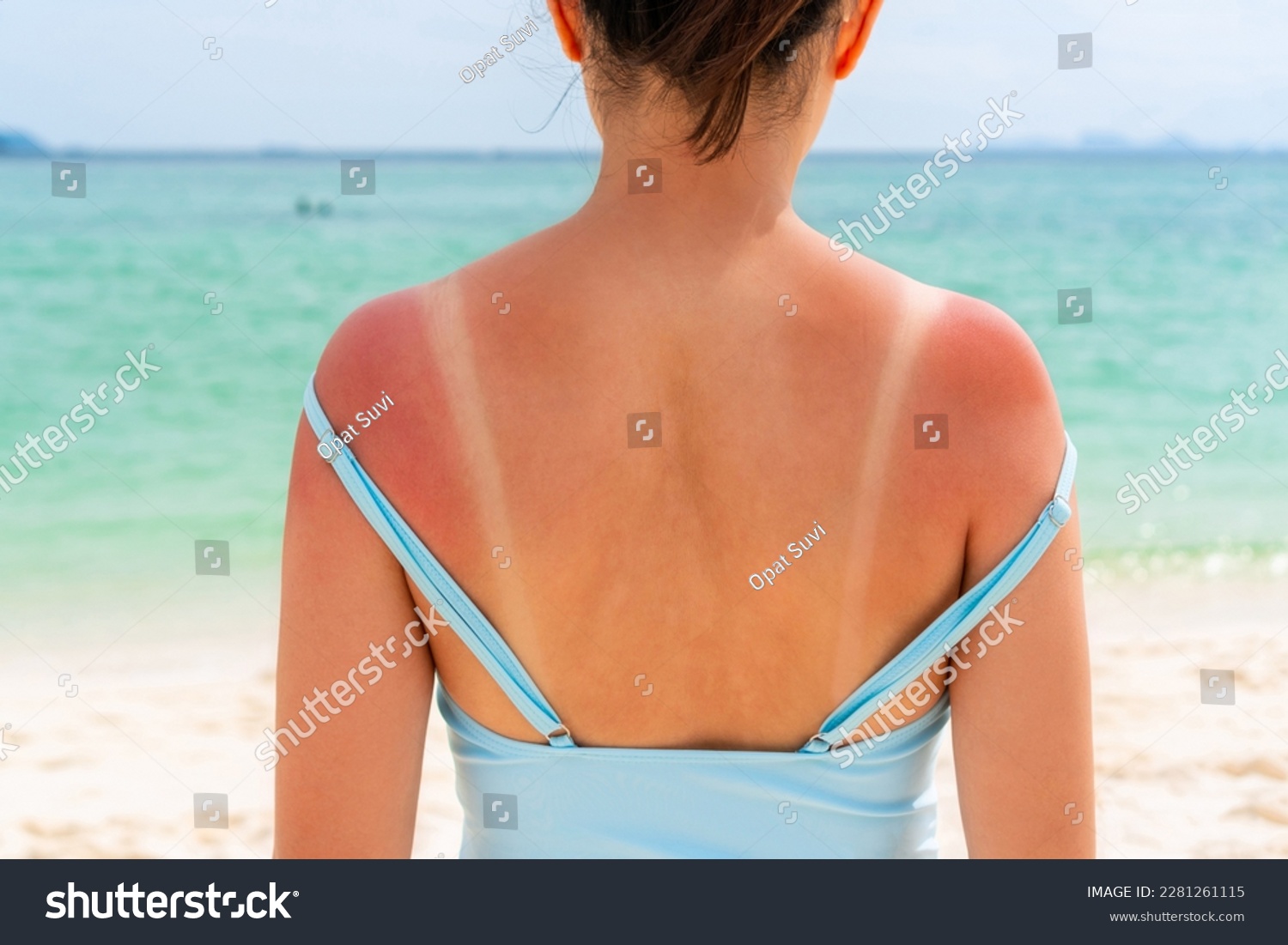 Sunburned skin on shoulder and back of a woman because of not using cream with sunscreen protection. Red skin sun burn after Sunbathing at the beach. Summer and holiday concept. Close up #2281261115