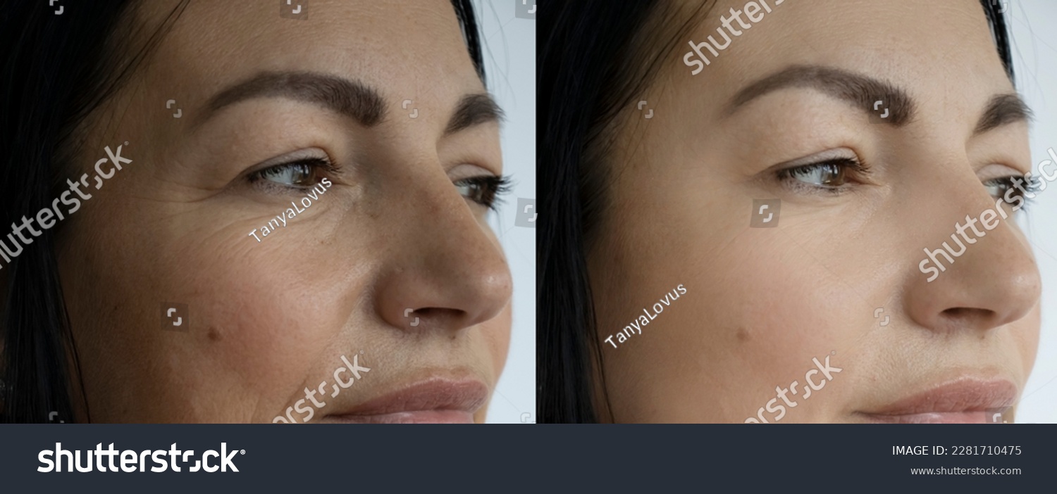 Face wrinkles before and after treatment #2281710475