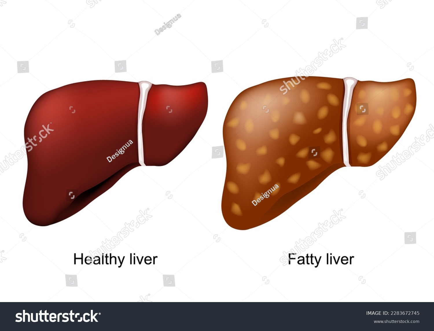 fatty liver disease. Healthy liver and hepatic - Royalty Free Stock ...