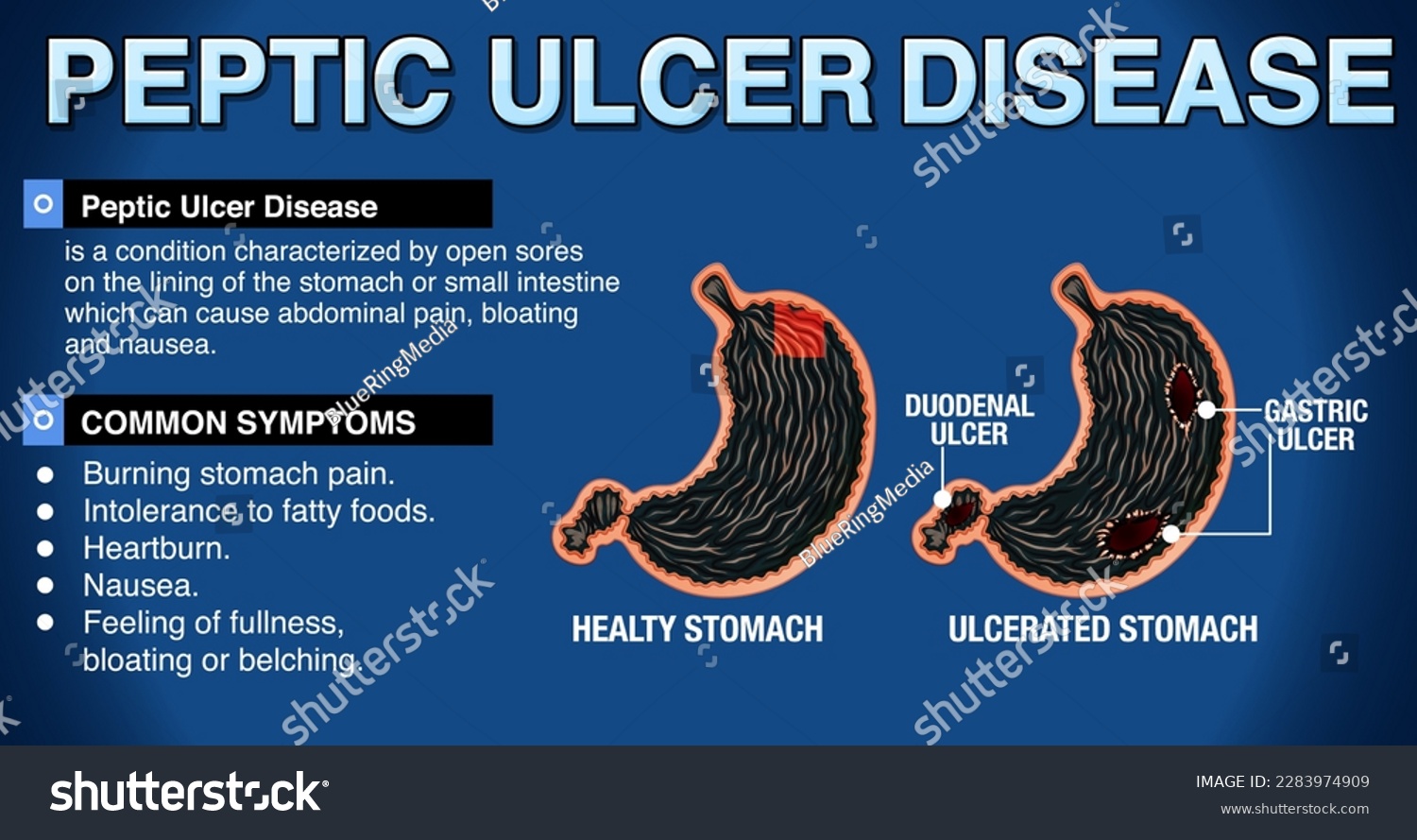 Peptic Ulcer Disease Explained Infographic - Royalty Free Stock Vector ...