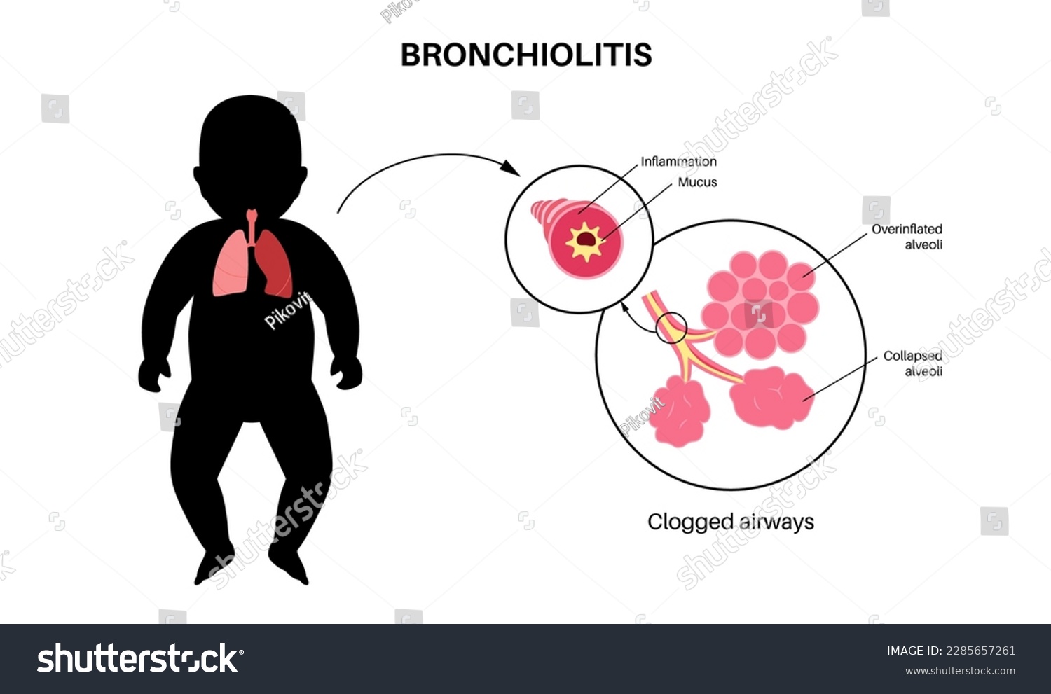 Bronchiolitis infection in young child body. - Royalty Free Stock ...