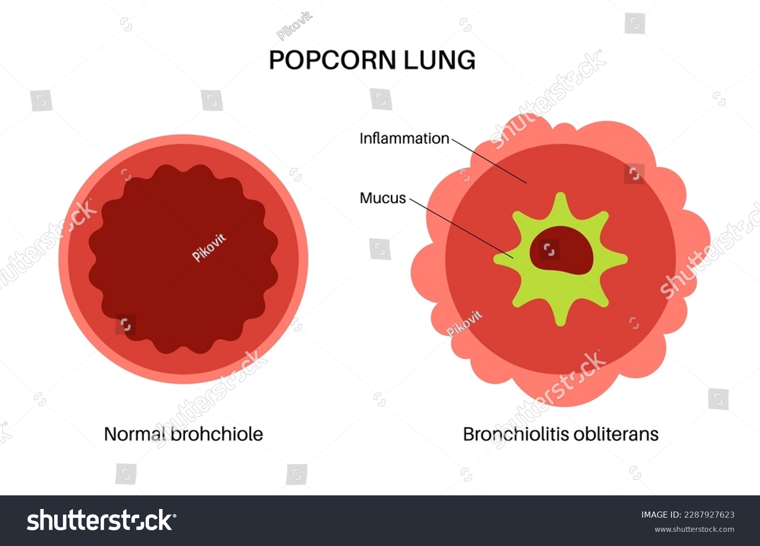 Bronchiolitis infection in young child body. - Royalty Free Stock ...