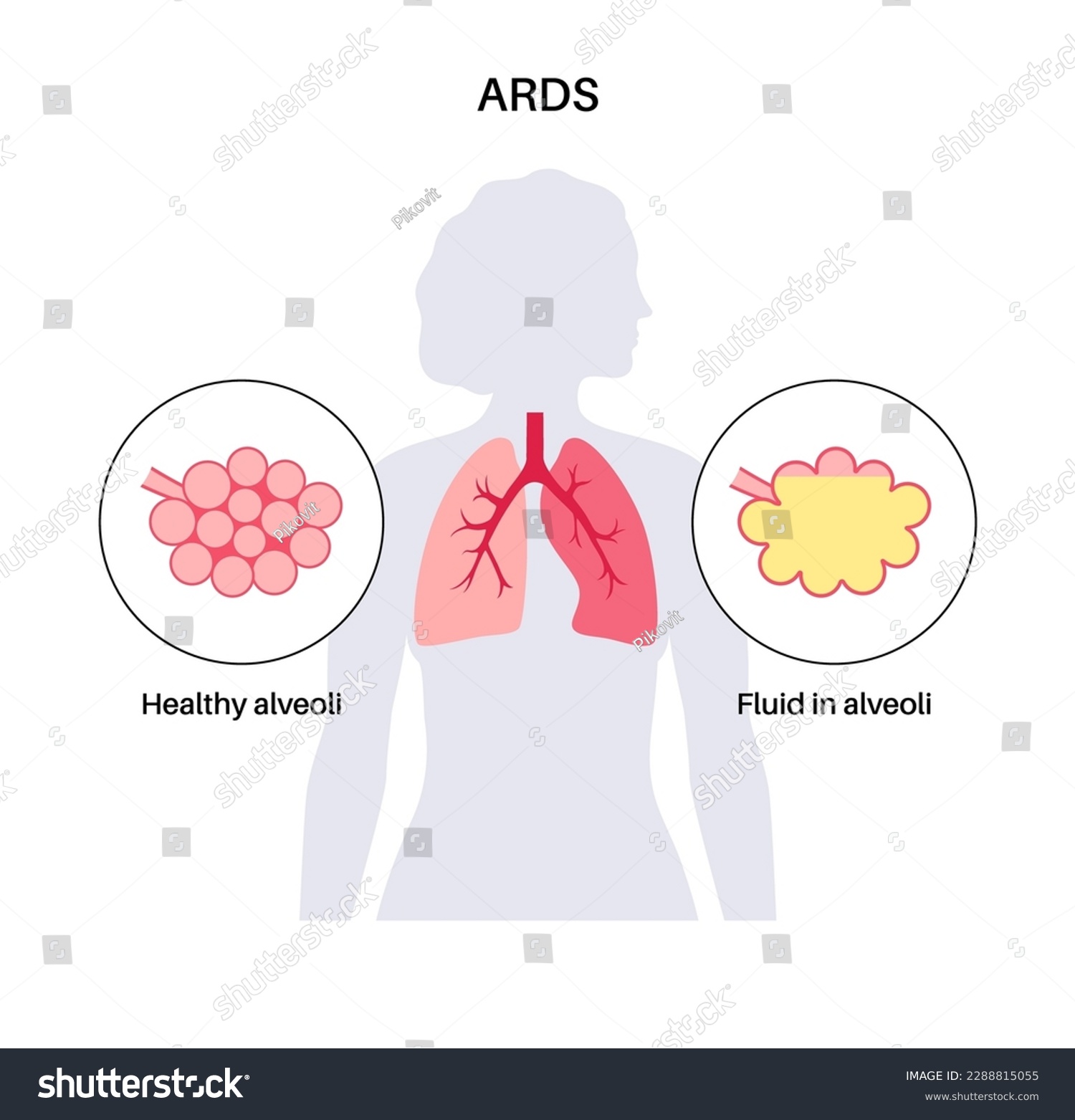 Acute Respiratory Distress Syndrome. Lungs - Royalty Free Stock Vector ...