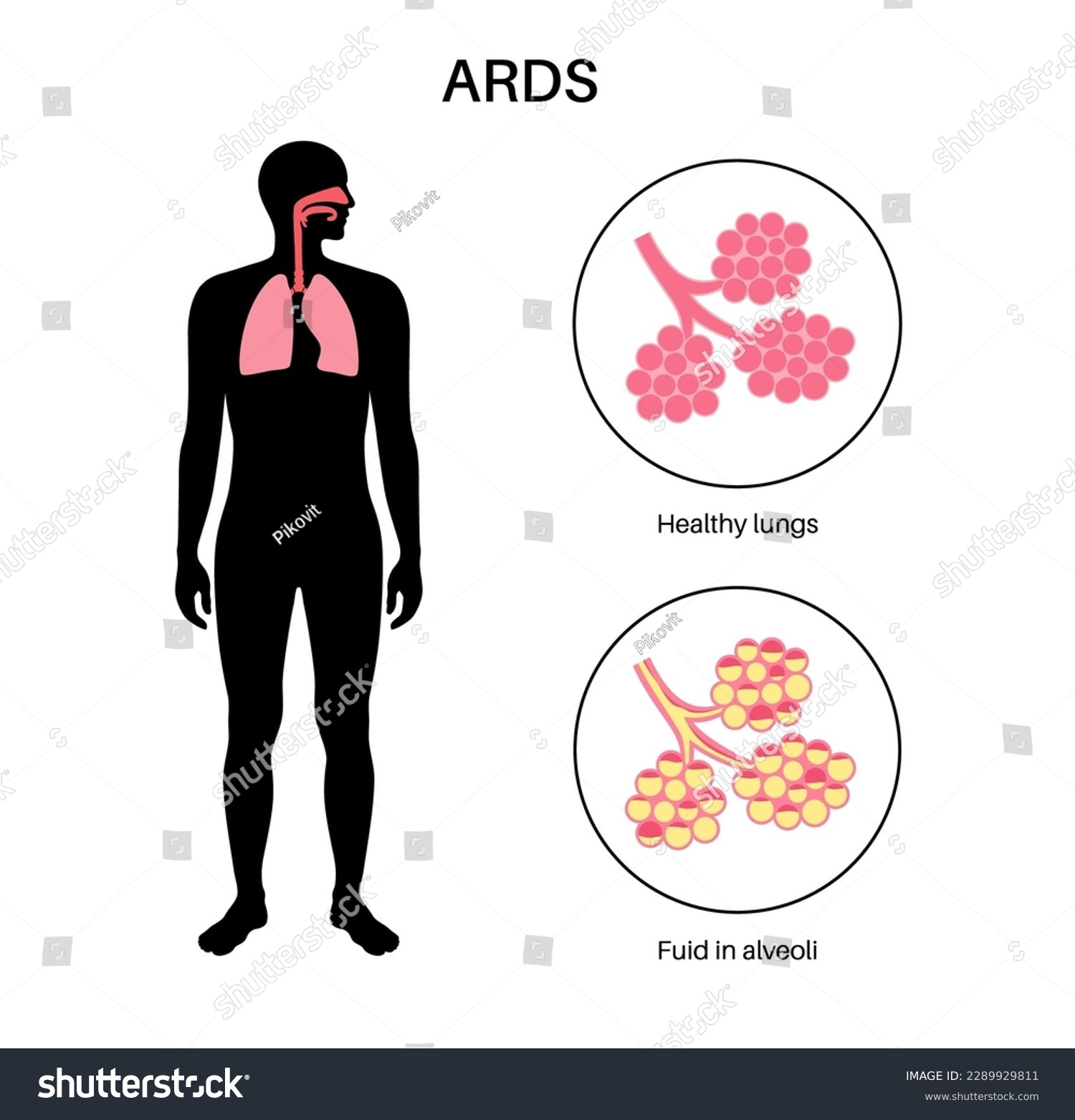 Acute respiratory distress syndrome. Lungs - Royalty Free Stock Vector ...