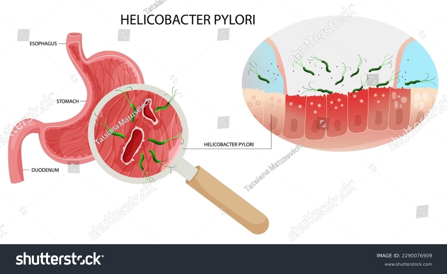 Helicobacter pylori infection in stomach ulcer - Royalty Free Stock ...