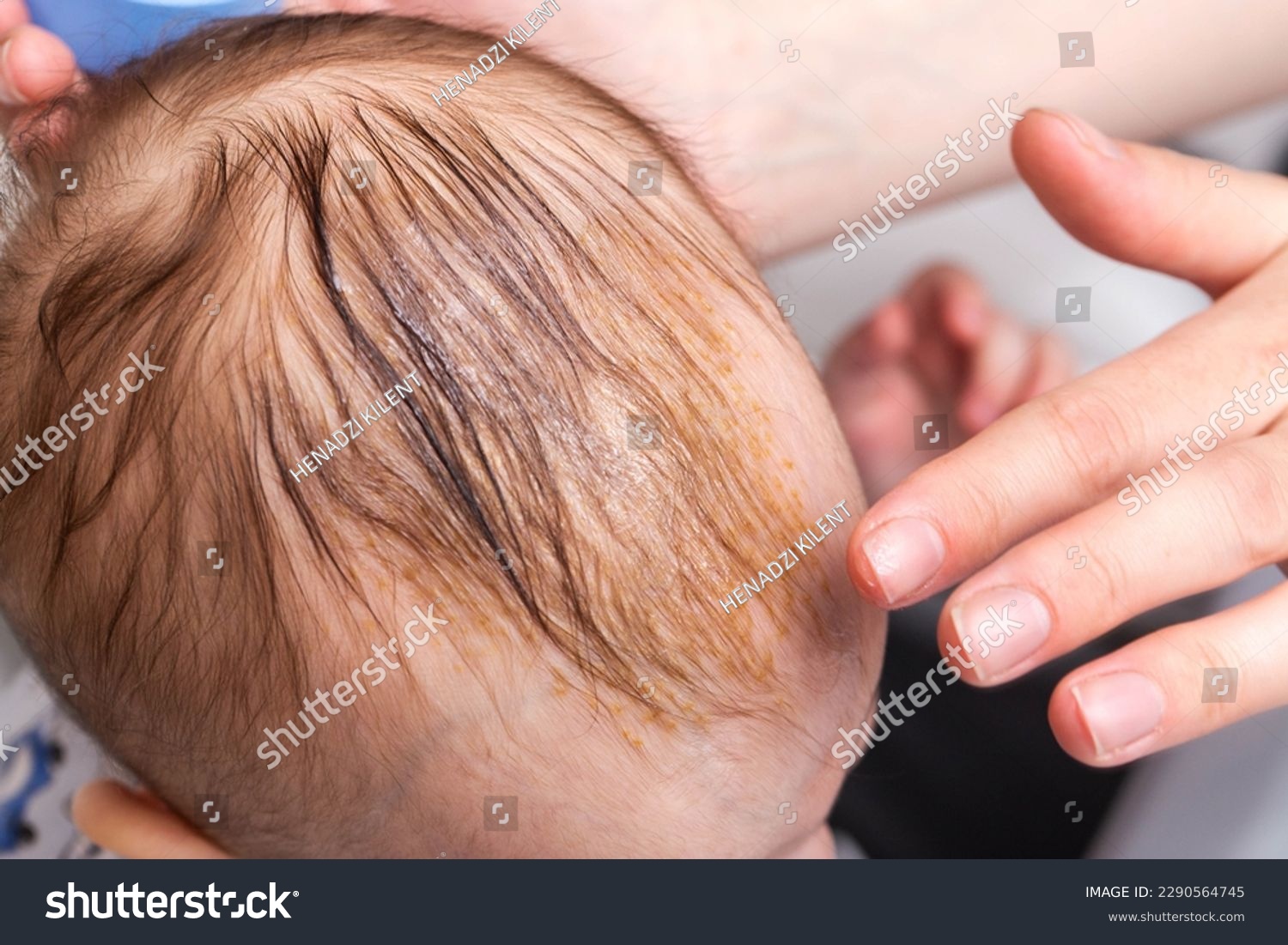 Smearing a seborrheic crust with baby oil on a child's head. Combing and removal of seborrheic crust, close-up #2290564745