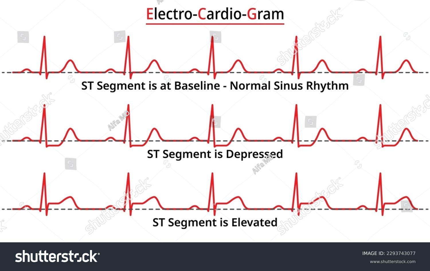 Set of ECG Common Abnormalities - Elevated ST - Royalty Free Stock ...