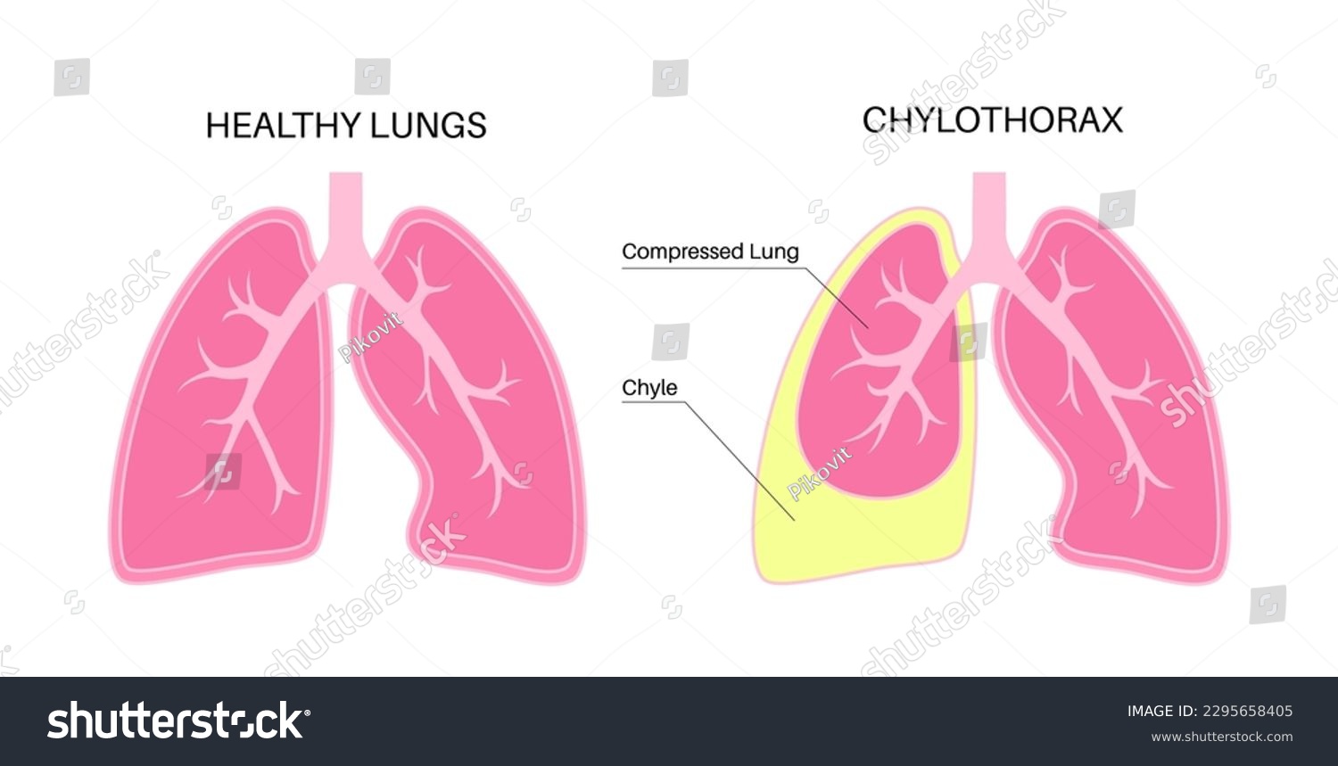 Chylothorax disease. Lymphatic fluid between - Royalty Free Stock ...