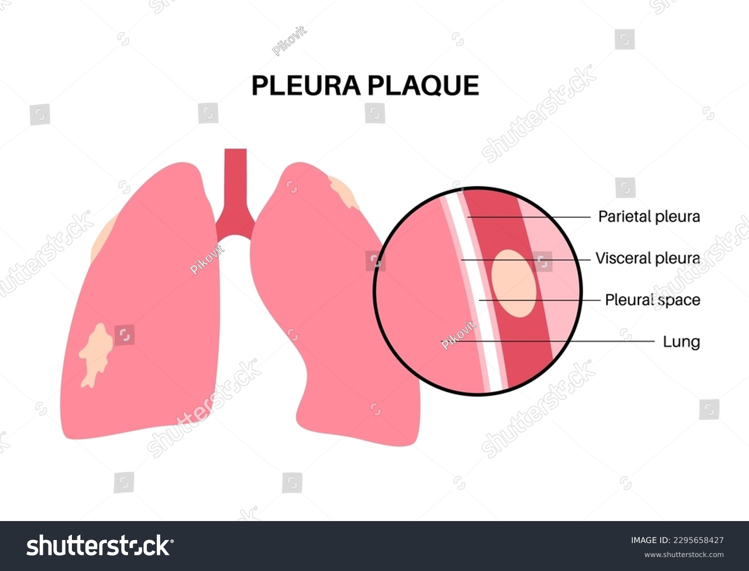 Spectacular Pleural Plaque With Presence Of Asbestos Photo in 4K Spectacular Pleural Plaque With Presence Of Asbestos Photo in 4K