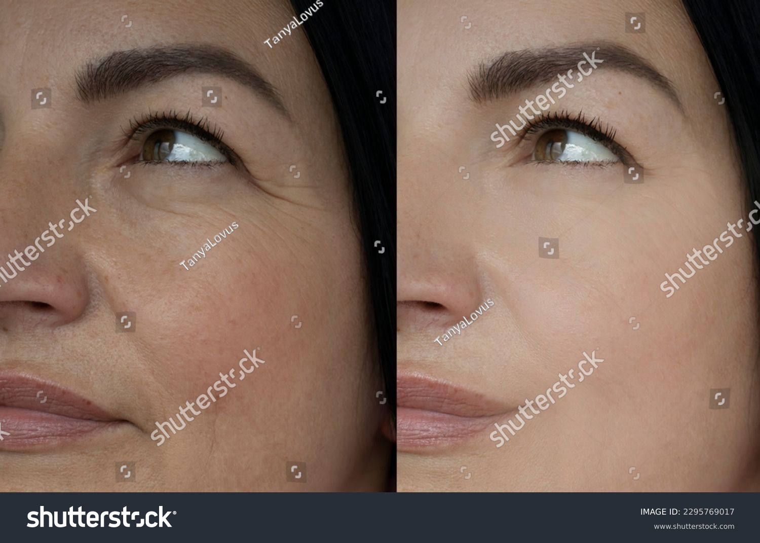 Woman face wrinkle before and after treatment #2295769017