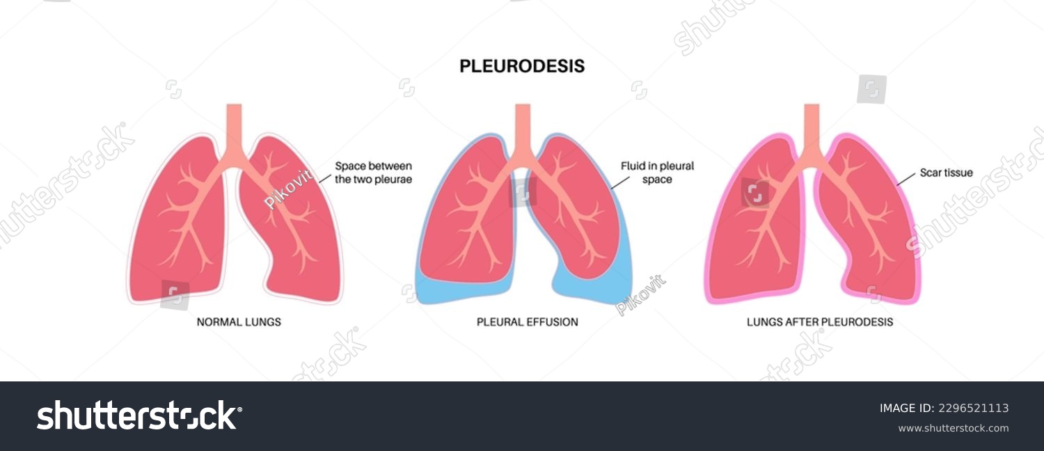 Chemical pleurodesis medical poster. Treats - Royalty Free Stock Vector ...