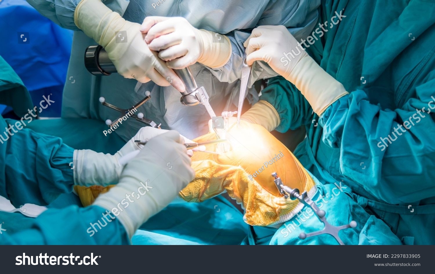 Doctor or surgeon in blue gown used robotic navigator total knee joint arthroplasty surgical instrument inside operating room.Medical technology in orthopedic surgery.Hand of people with a saw. #2297833905