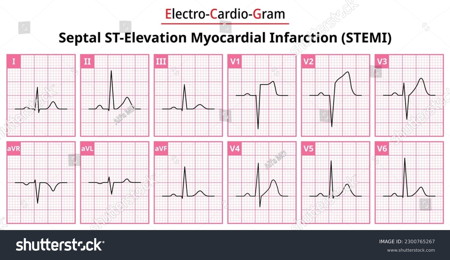 Septal STEMI (ST-Elevation Myocardial Infarction - Royalty Free Stock ...