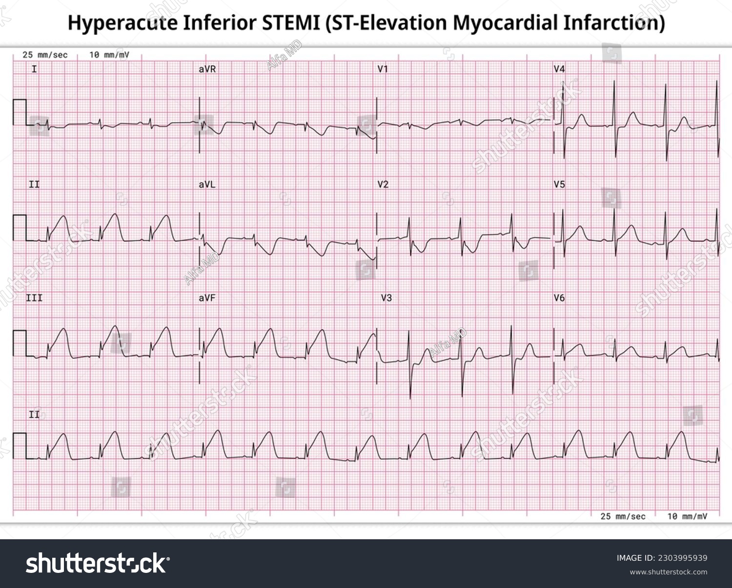 Hyperacute Inferior STEMI (ST-Elevation - Royalty Free Stock Vector ...