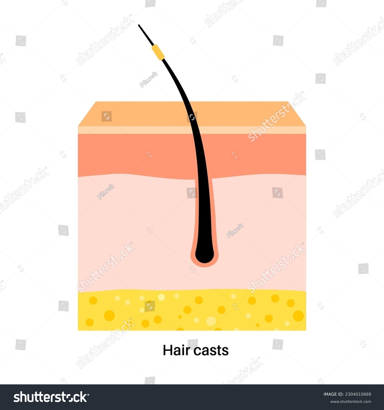 Hair casts problem. Head disease concept. Shafts - Royalty Free Stock ...