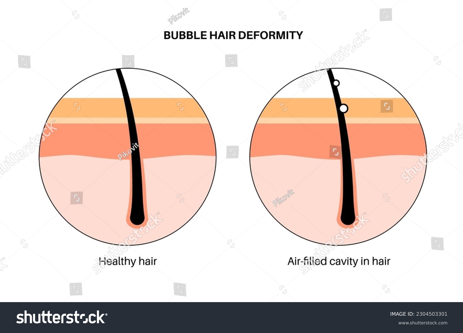 bubble hair deformity        
        <figure class=