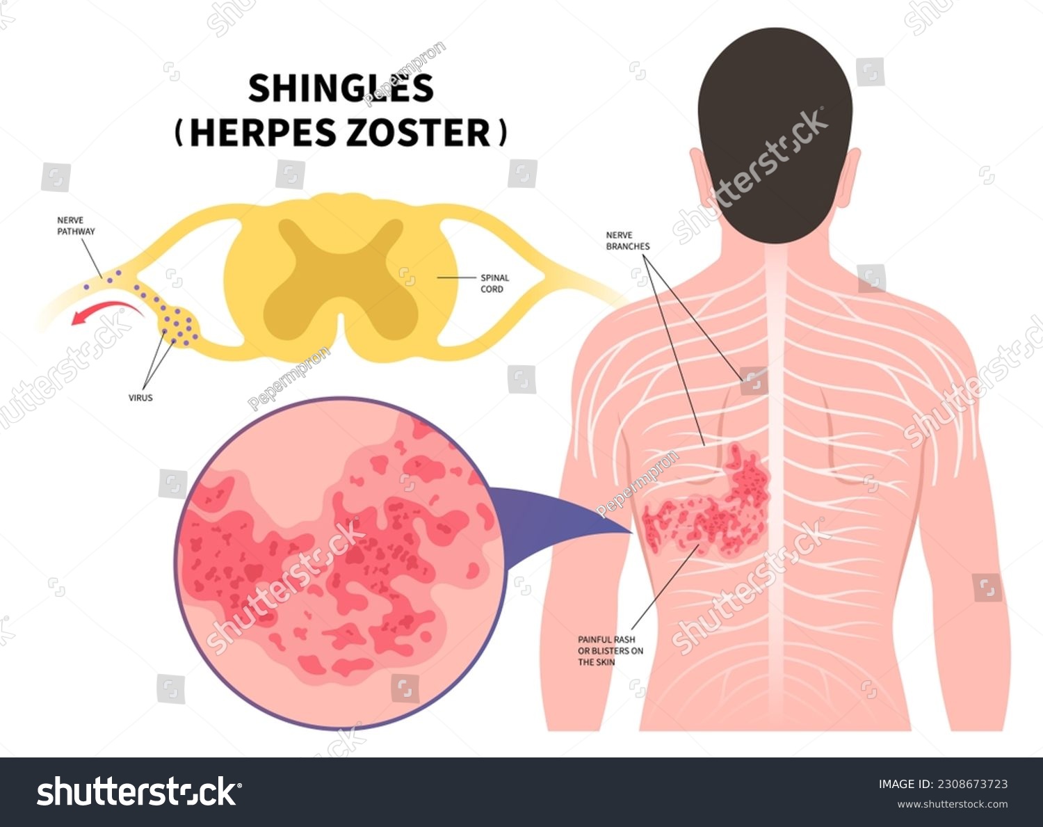 Nerve medical anatomy with Shingles Herpes - Royalty Free Stock Vector ...