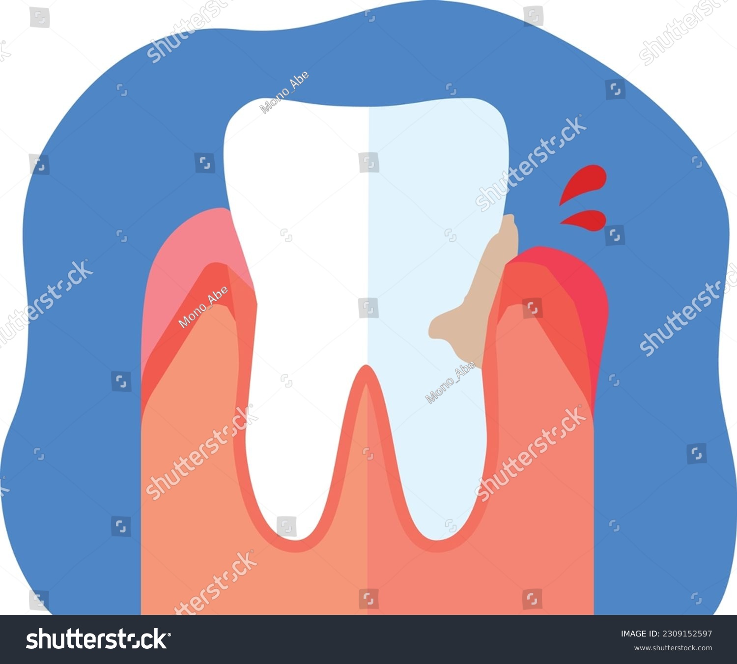 Illustration of swollen and bleeding gums - Royalty Free Stock Vector ...