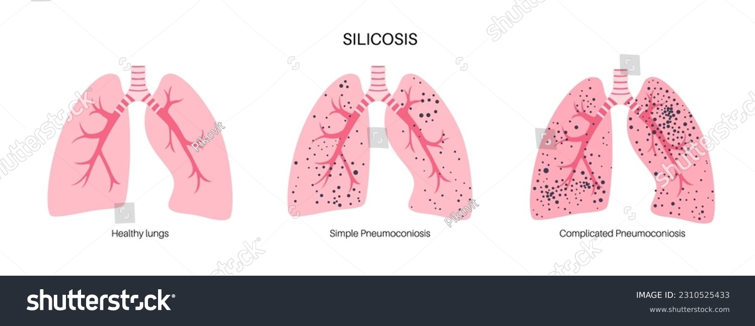 Silicosis anatomical poster. Lung disease, - Royalty Free Stock Vector ...