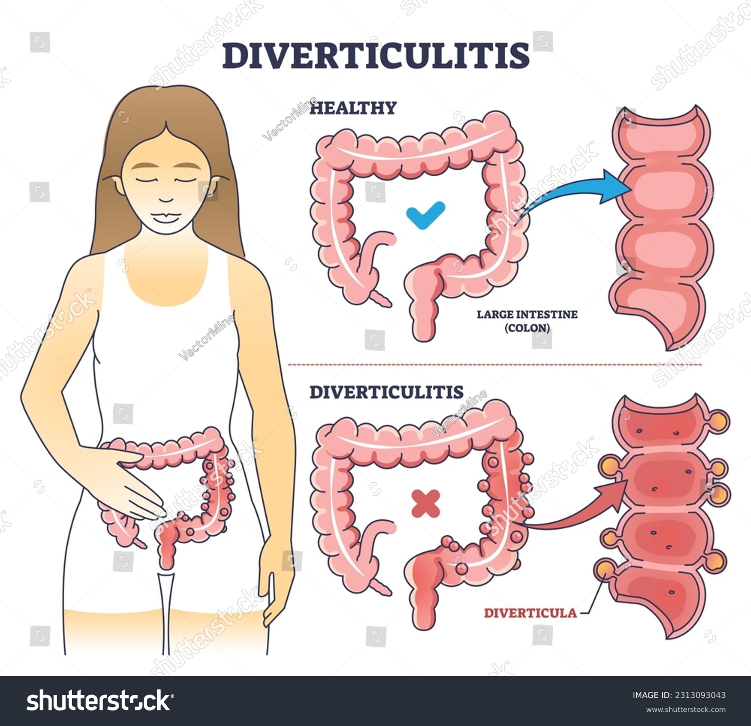 Diverticulitis As Digestive Conditions For Large - Royalty Free Stock 