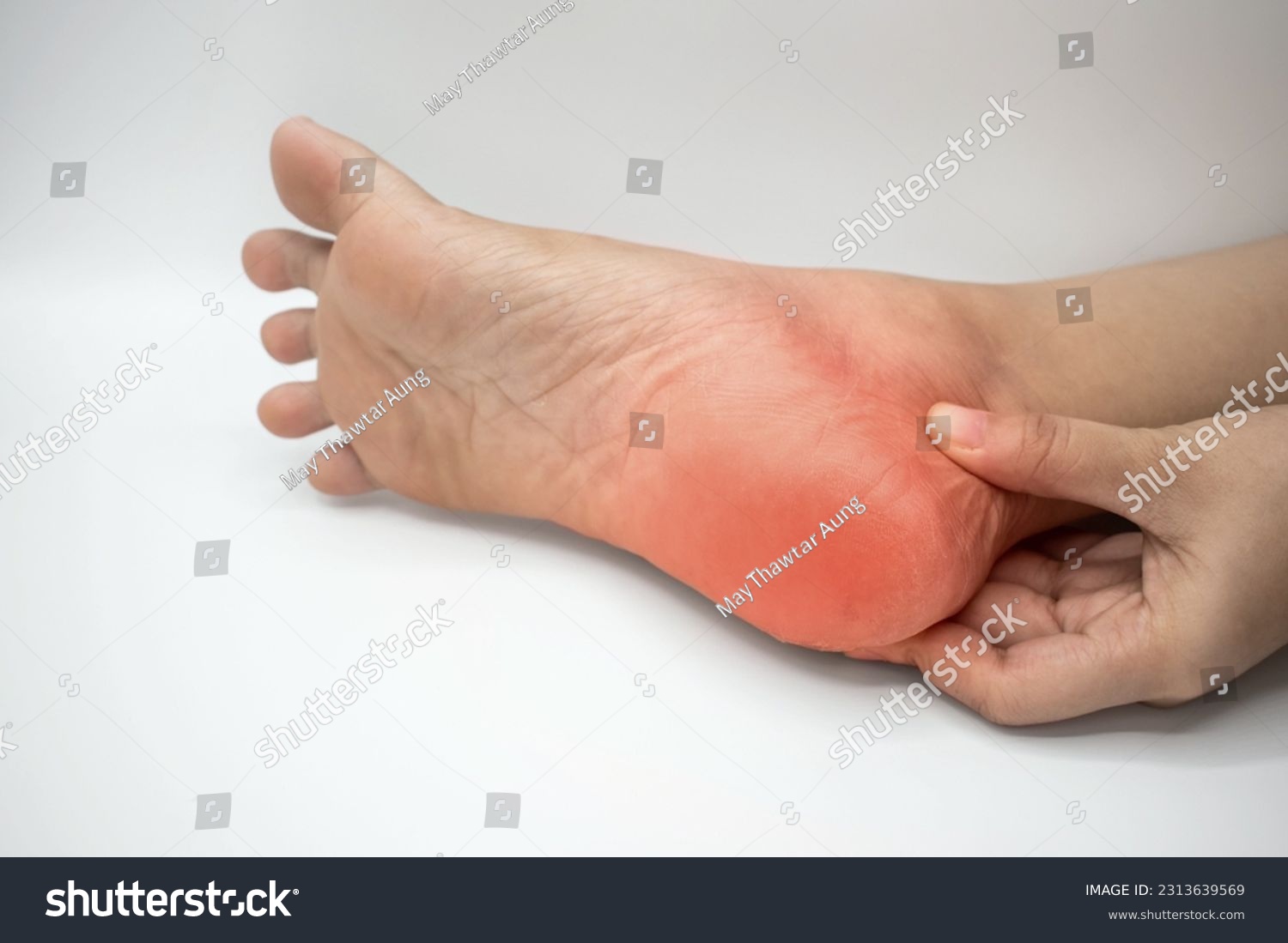 Inflammation at heel of Asian young woman. Concept of foot pain, plantar fasciitis, achilles tendonitis or heel spurs. #2313639569