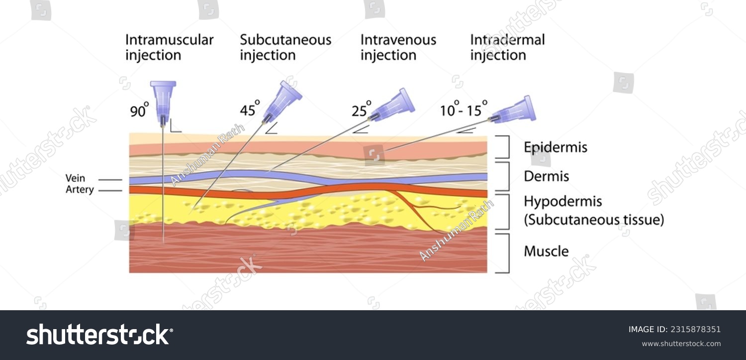 Types of injection vector illustration. - Royalty Free Stock Vector ...